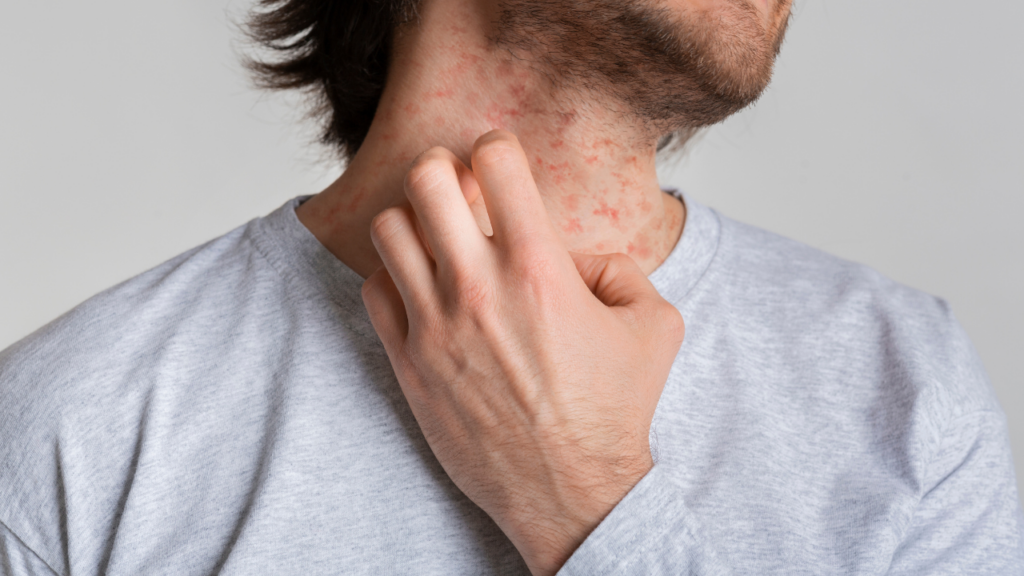 Buy the original Causes of Skin Itching and How to Cure It in Lagos Nigeria