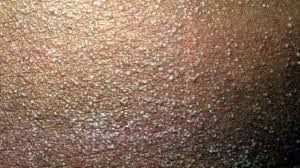 Original How to Treat Skin Rashes in Lagos in Lagos Nigeria Buy the original How to Treat Skin Rashes in Lagos in Lagos Nigeria