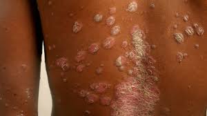 Original How to Treat Skin Rashes in Lagos in Lagos Nigeria Buy the original How to Treat Skin Rashes in Lagos in Lagos Nigeria