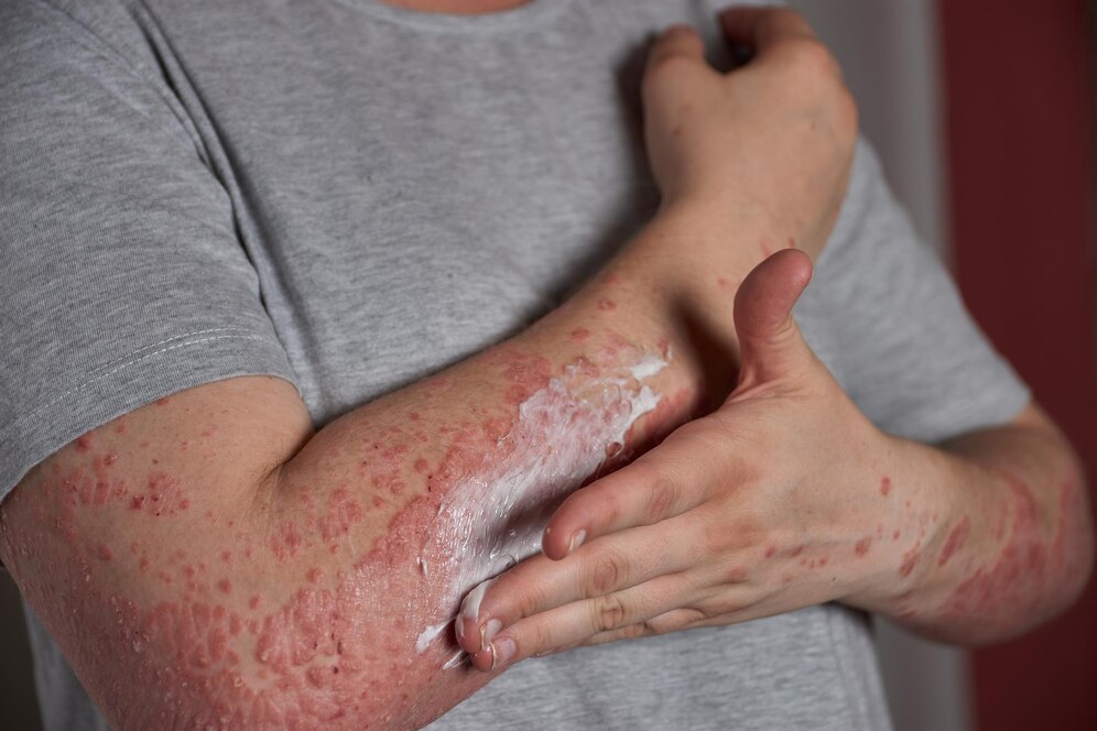 Original Simple Tips for Managing Psoriasis in Lagos in Lagos Nigeria Buy the original Simple Tips for Managing Psoriasis in Lagos in Lagos Nigeria