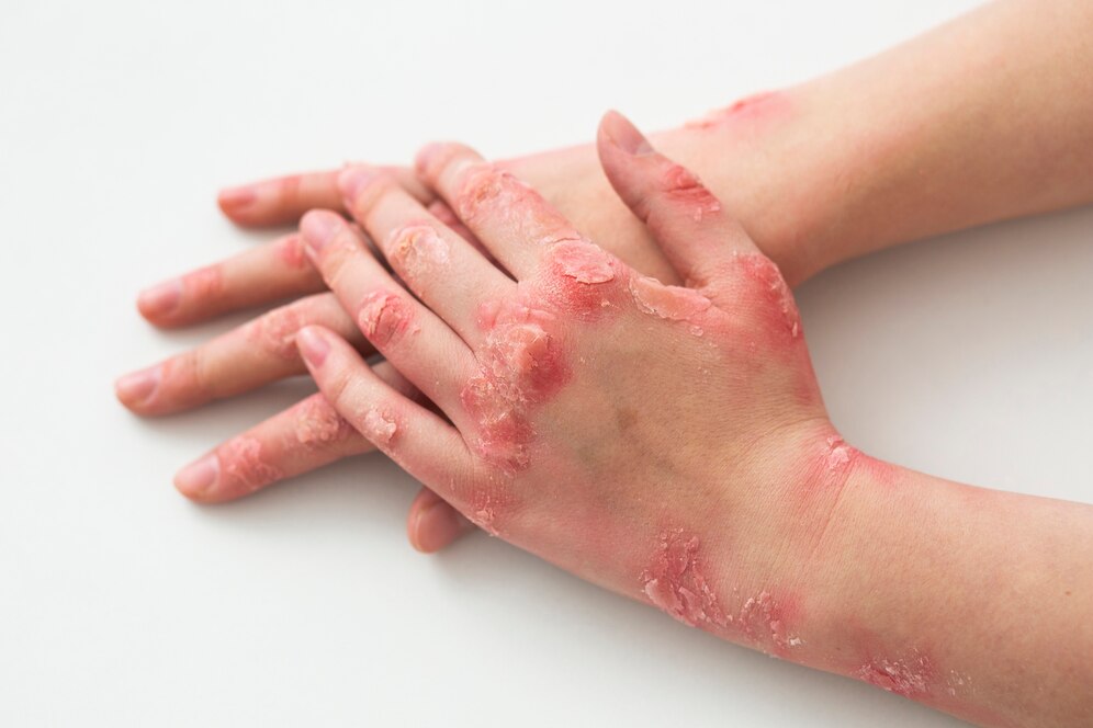 Original Simple Tips for Managing Psoriasis in Lagos in Lagos Nigeria Buy the original Simple Tips for Managing Psoriasis in Lagos in Lagos Nigeria